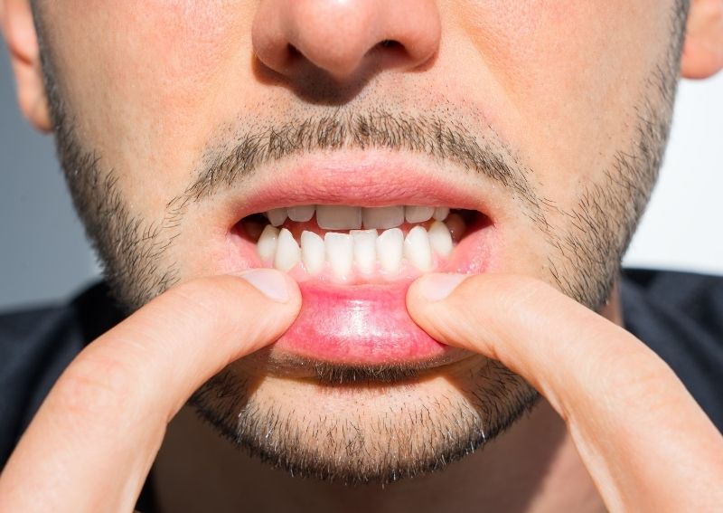 Underbite: Can You Fix It Without Underbite Surgery?