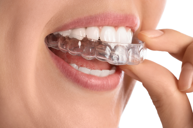  A girl applying clear retainers.