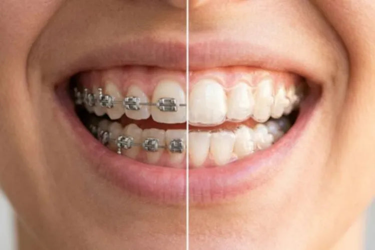 An image shows clear aligners vs traditional braces