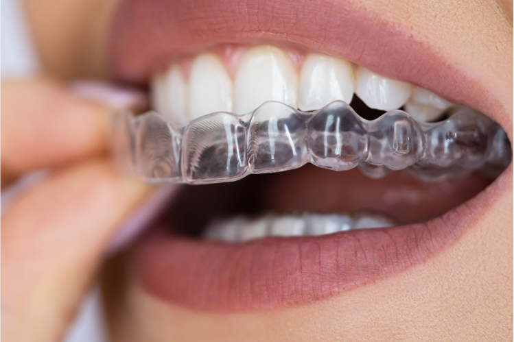 A woman wearing clear aligners