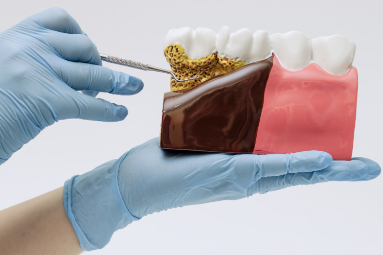 A model showing gum disease and bone loss that makes aligner treatment unsuitable