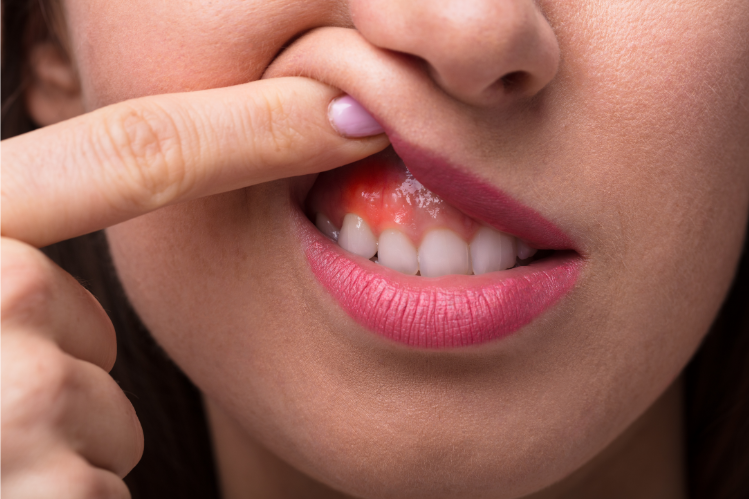 Gingivitis: Symptoms and Causes & How to Treat?