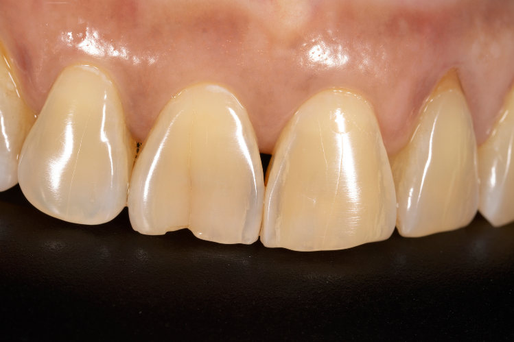 A close-up of the front chipped tooth