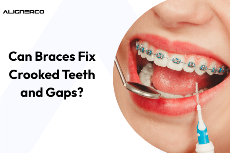 Can Braces Fix Crooked Teeth and Gaps?