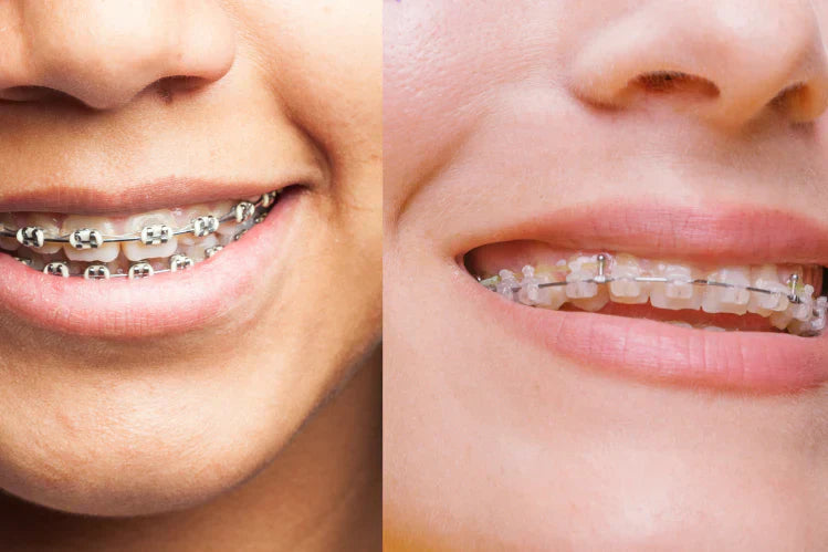 An image of a side-by-side comparison of ceramic vs white braces