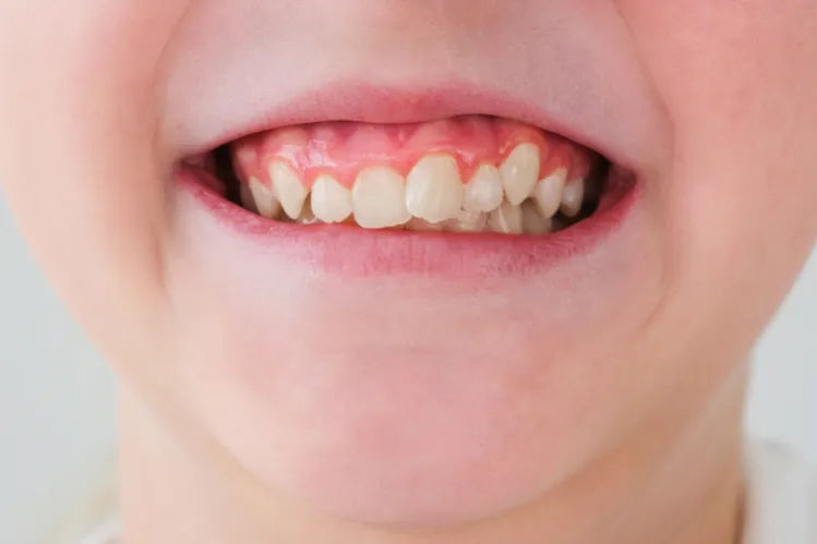 A child suffering from crooked teeth.
