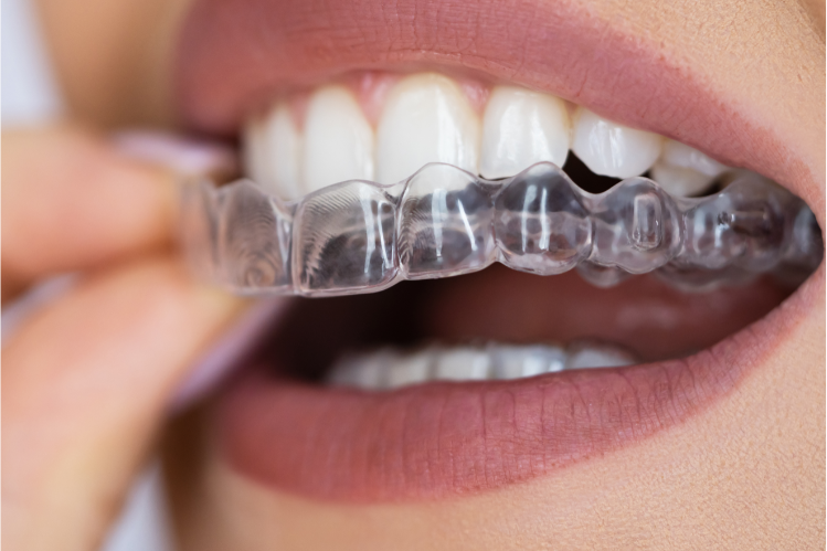 Clear aligners are easily embraced.