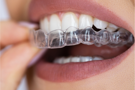 Clear aligners are easily embraced.