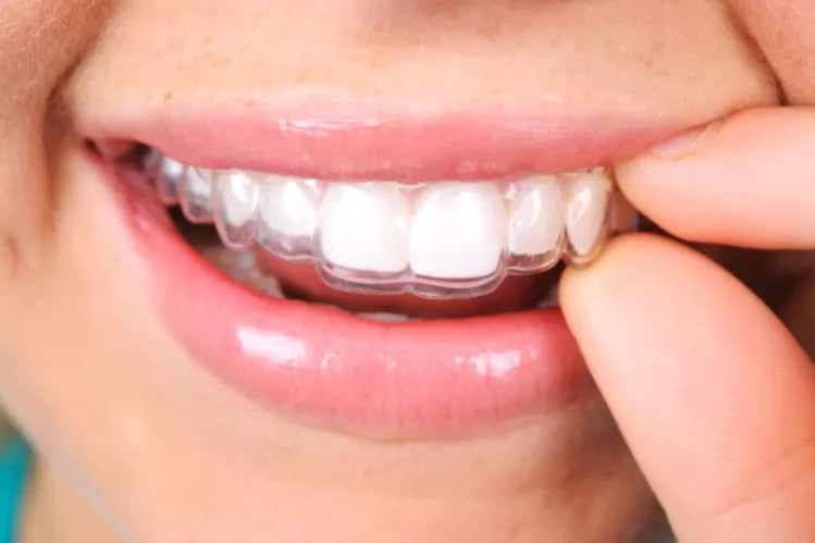 A girl applying dental retainers after teeth straightening.