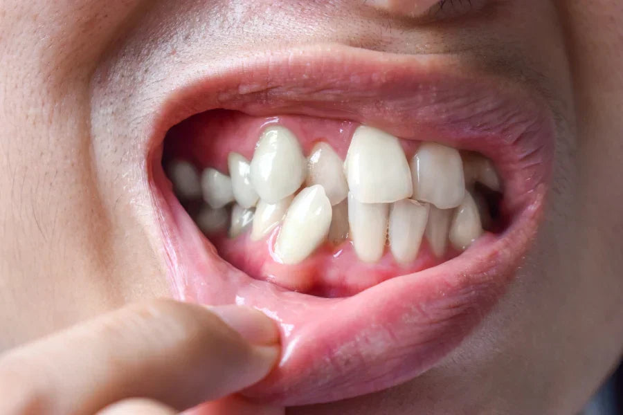 A close-up of crooked teeth
