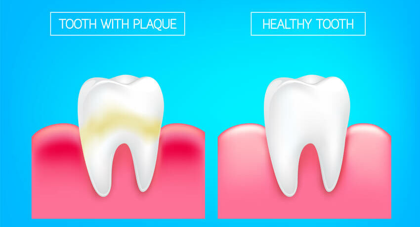 An illustration of a comparison between the healthy tooth and tooth with plaque