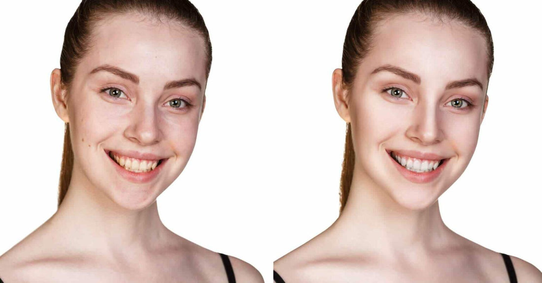 What Is a Smile Makeover and Do You Need One?