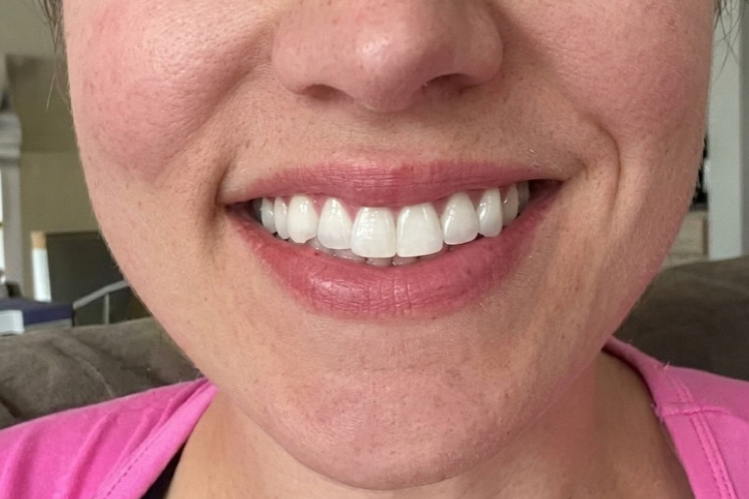 Close-up of a woman's bright smile with straight teeth