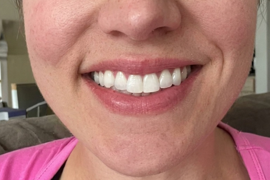 Close-up of a woman's bright smile with straight teeth