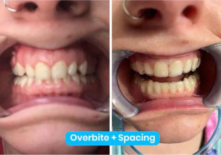 Teeth Straightening for Adults: An 18+ Analysis