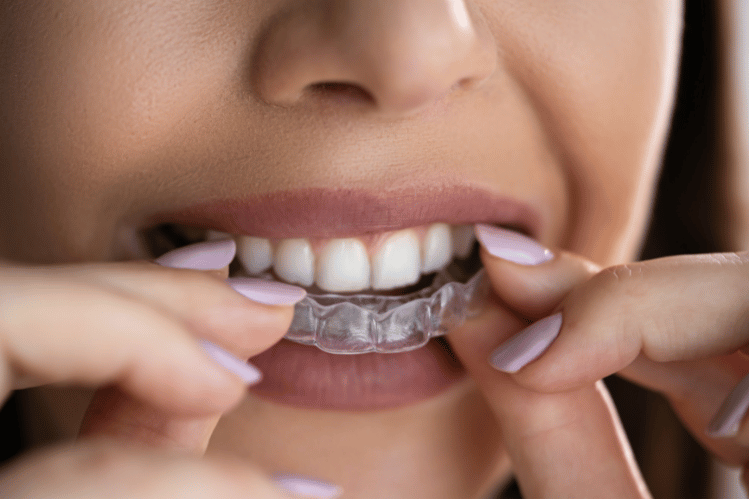 A Teen's Guide to Clear Aligners