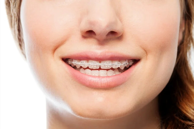 Is Invisalign Cheaper Than Braces? 7 https://alignerco.com/cdn/shop/articles/clear_braces_deb05fab-5a57-4bdb-9096-9d0bad97029a.webp?v=1747028856