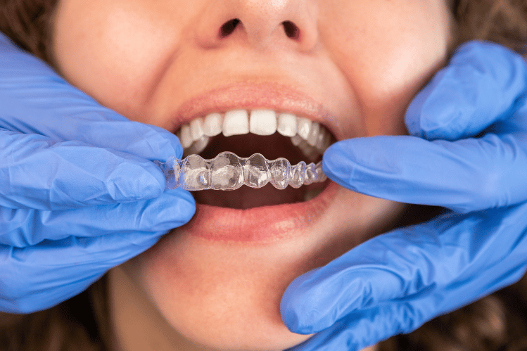 clear aligners 