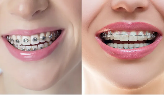 The Difference between Metal Braces and Ceramic Braces