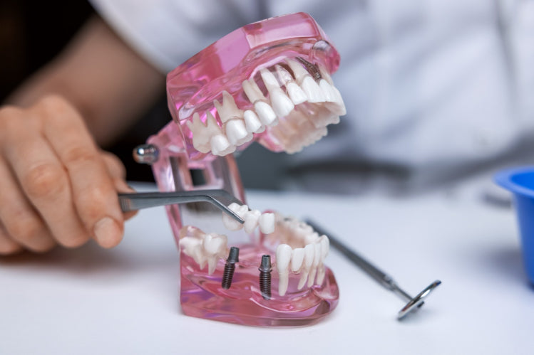 What Is an Implantologist & How Do They Differ from Dentists?