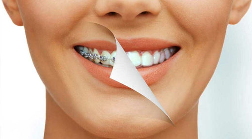 Teeth Straightening for Adults: An 18+ Analysis