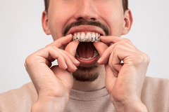 Can Retainers Move Teeth Back On Their Own?