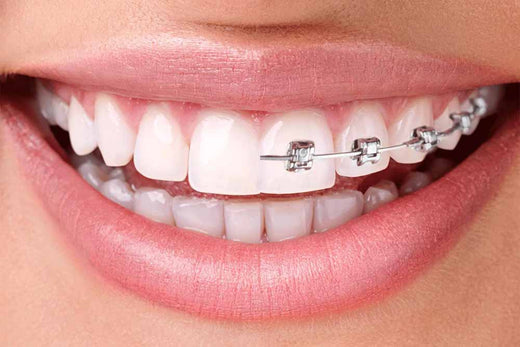 No More Metal Braces... Wear Invisible Aligners