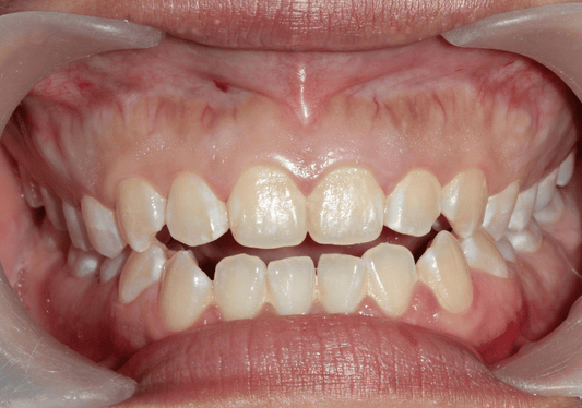 Orthodontic Fixes for Open Bite: Get the Smile You Want