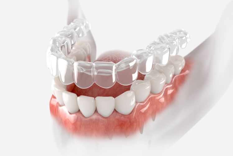 clear retainers for teeth straightening