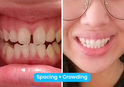 Affordable, Engaging, and Effective Aligners for a Confident Smile