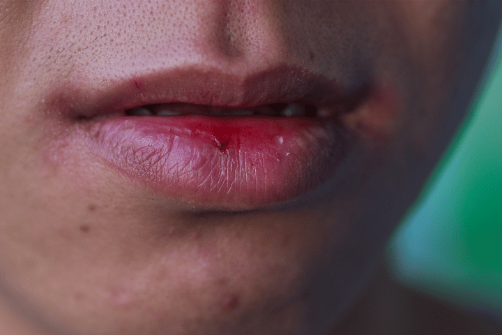 Prevent dry mouth during clear aligner treatment