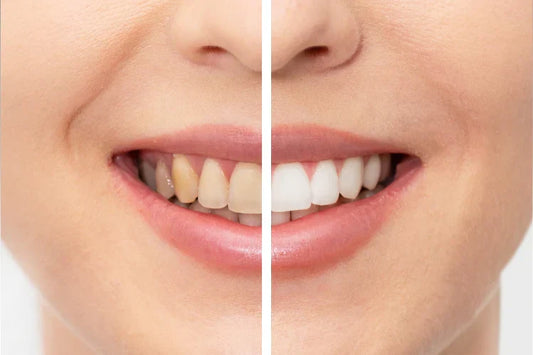 Before and after of whitened teeth