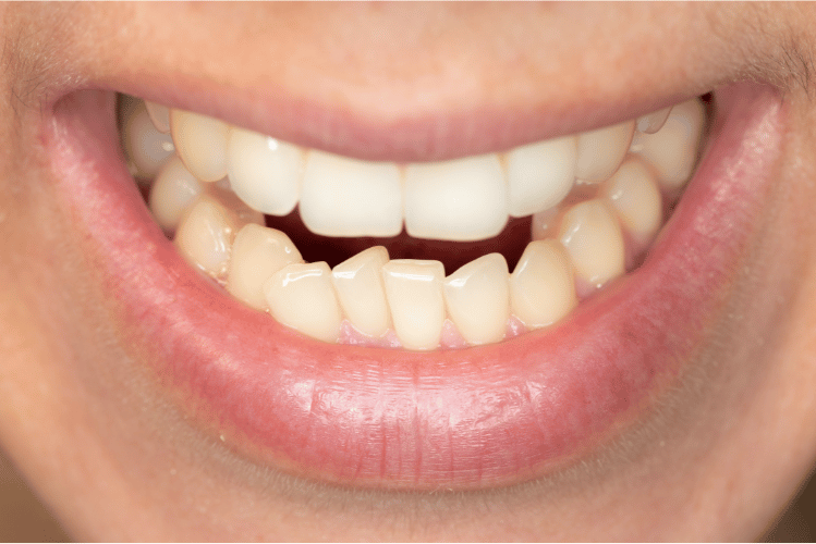 Can Clear Aligners Fix Crowded Teeth?