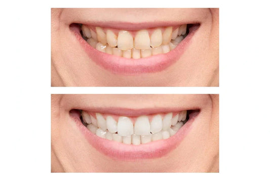 Teeth Whitening Before and After