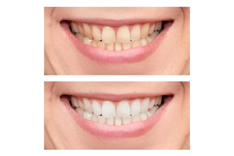 Teeth Whitening Before and After