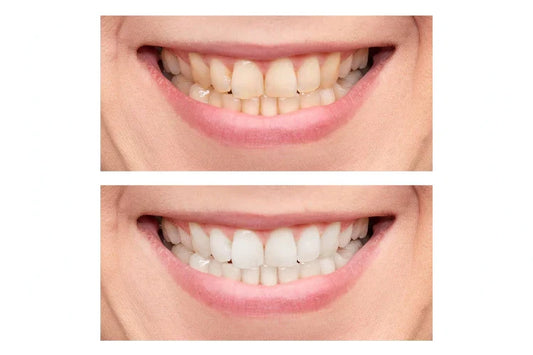 Teeth Whitening Before and After