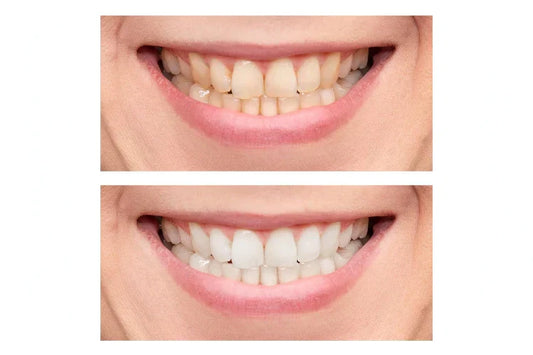 Teeth Whitening Before and After