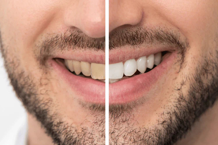 Teeth Whitening and Smoking