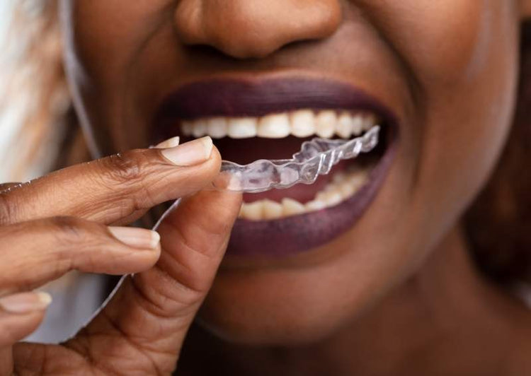 How to Straighten Your Teeth At Home | AlignerCo