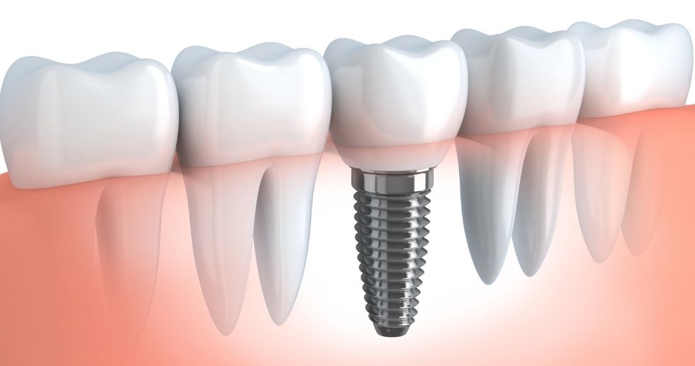 Time to Consider Dental Implants?