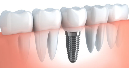 Time to Consider Dental Implants?