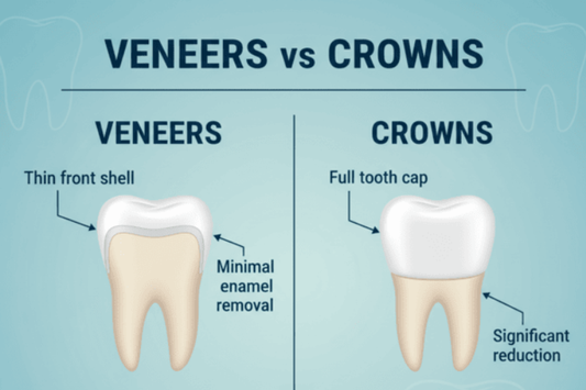 veneers-vs-crowns