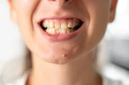 Woman with malocclusion.