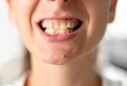 Understanding Malocclusion: Causes, Types, and Effective Treatments