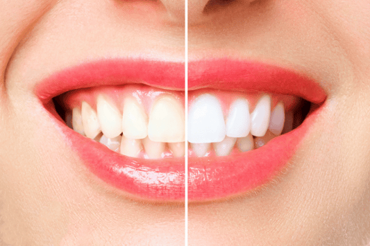 Clear aligners with teeth whitening