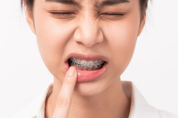 The Risks and Dangers of Straightening Your Teeth with Metal Braces