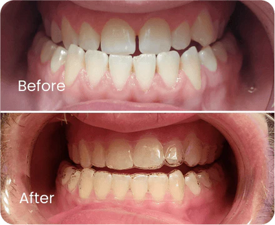 Cross Bite
