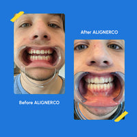 AffordableTeeth Staightening SmileAdvantage Plan | AlignerCo