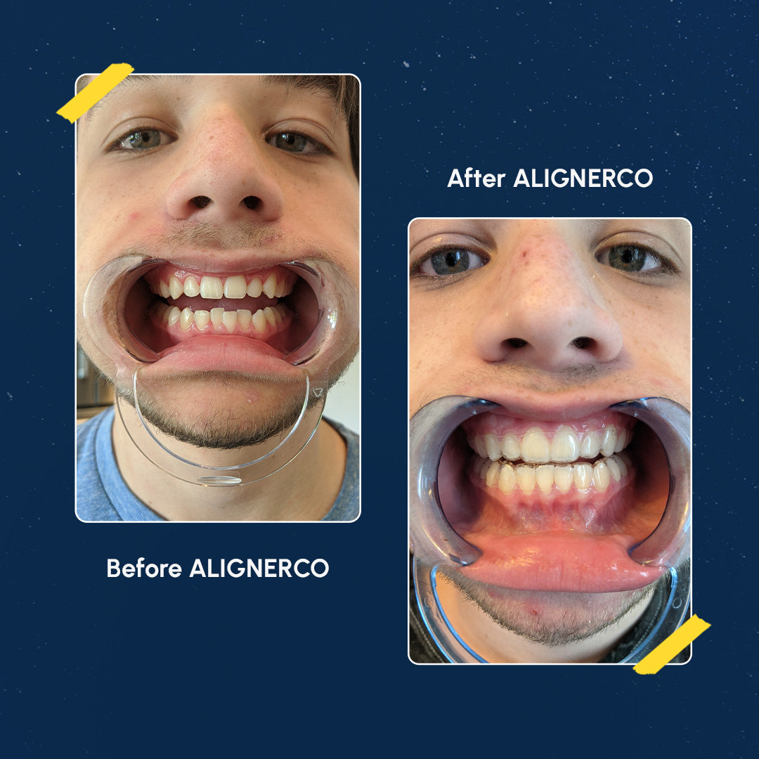 nightflex-plan-night-aligners-in-12-easy-payments