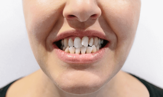 What Are Crowded Teeth?